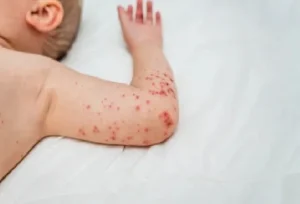 El Ministerio de Salud confirma las dos primeras muertes por sarampión en Guatemala